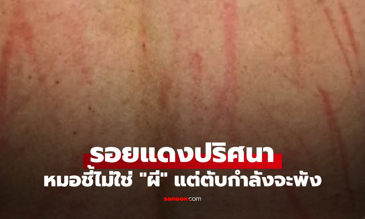 รอยแดงทั่วตัว เชื่อเป็นฝีมือ “ผี” แพทย์ชี้เป็นสัญญาณ “ตับ” ขอความช่วยเหลือ