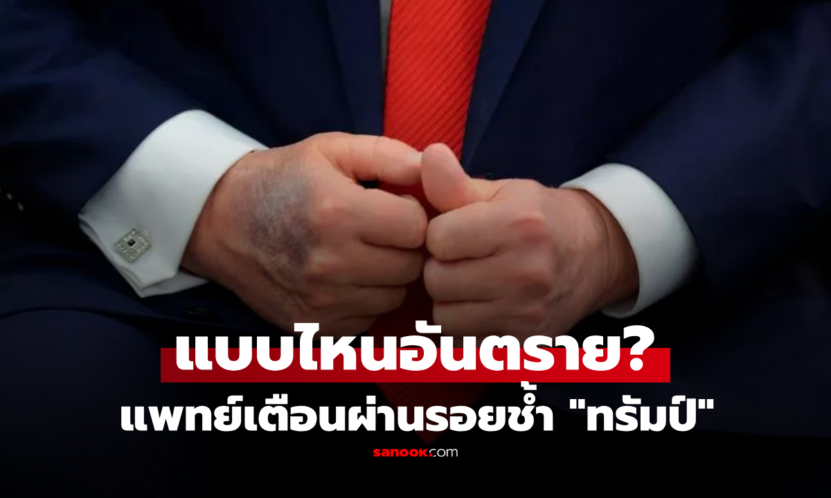 รอยช้ำแบบไหน “อันตรายถึงชีวิต” แพทย์เตือนผ่านเคส “ทรัมป์” เส้นเลือดดำบกพร่อง!